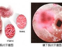 结肠炎的症状与治疗