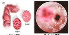 结肠炎的症状与治疗
